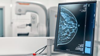 Médicos chinos desarrollan prueba de detección de cáncer de mama con IA en teléfonos inteligentes
